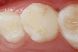 کامپوزیت یا آمالگام؟ مواد دندانی سیاه و سفید 3 Glass ionomer