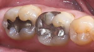 کامپوزیت یا آمالگام؟ مواد دندانی سیاه و سفید 2 amalgam dental filling